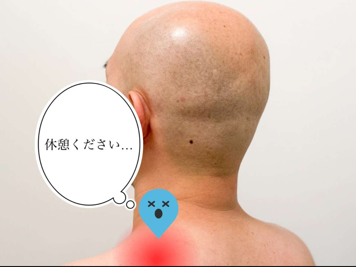 【名古屋/桜山】肩こりの正体は、肩の働きすぎでした