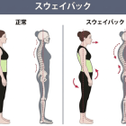 スウェーバック姿勢とは？ 骨盤を立てるだけでは改善しないのはなぜ？